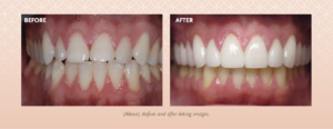 Before and after photo of an Aspen Dental of Cache Valley cosmetic dentistry patient.